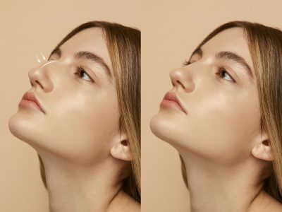 Before and after rhinoplasty nose reshaping surgery results